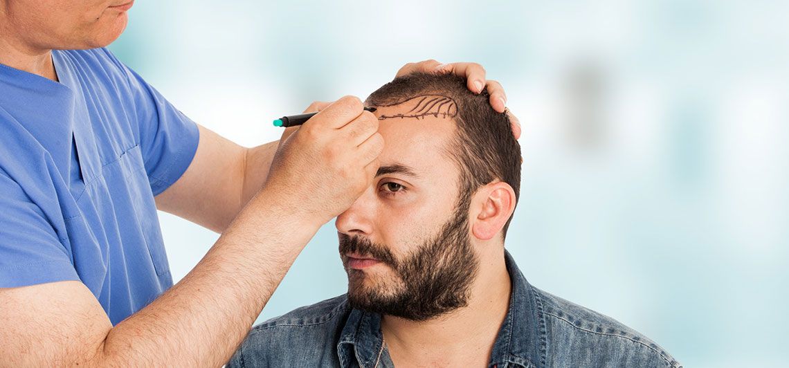 Fue As The Latest Technology In Hair Transplantation