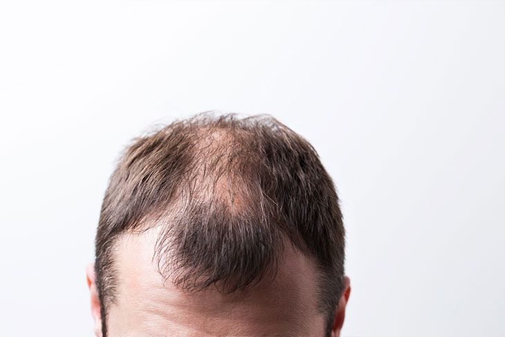 When Is Hair Transplantation Done?
